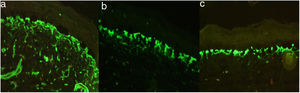 Inmunofluorescencia del caso 1. Patrón de tinción reticulado positivo en la membrana dermoepidérmica para colágeno iv (a), colágeno vii (b) y laminina 332 (c); patrón característico de síndrome de Kindler.