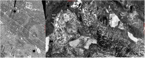 Microscopia electrónica (caso 1). Cortes ultrafinos seriados de 100nm de espesor mostrando ampollas (flechas) a diferentes niveles de la unión dermo-epidérmica, con desmosomas y fibrillas de anclaje sin alteraciones.