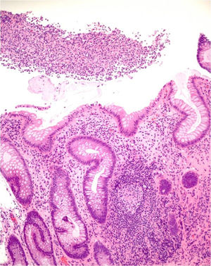 Estudio histológico de la mucosa rectal de un paciente con linfogranuloma. Ulceración con restos fibrinoleucocitarios, infiltrado linfoplasmocitario de lámina propia con criptitis aguda, abscesos crípticos y un granuloma epitelioide.