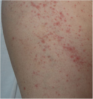 Rash exantemático inespecífico, de distribución perifolicular en el contexto de COVID-19.