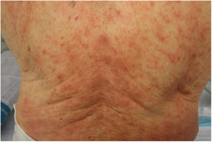 Exantema maculopapular en un paciente con COVID-19 y neumonía bilateral secundaria, que recibió diferentes fármacos. El diagnóstico diferencial con respecto a una toxicodermia es difícil.