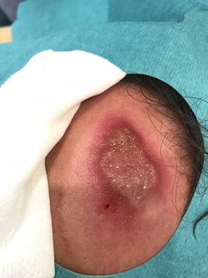 Leishmaniasis cutánea. Placa única, indurada, con superficie costrosa localizada en la frente.