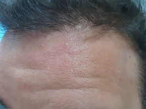 Leishmaniasis cutánea ya tratada. Cicatrices atróficas con hiperpigmentación periférica localizadas en la frente, tras finalizar las ocho sesiones de terapia fotodinámica y de meglumina intralesional.