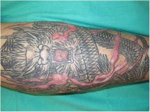 Tatuaje en la pierna izquierda. Áreas coloreadas de rojo, bien delimitadas, se aprecian sobreelevadas y engrosadas, sin reacción inflamatoria alrededor.