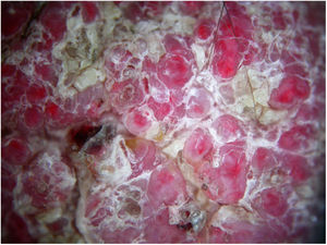 Imagen de dermatoscopia. Estructuras redondeadas y ovaladas de distintos tamaños de centro eritematoso y periferia rosada separadas entre sí por escamas amarillentas.