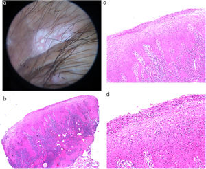 a) Dermatoscopia de la lesión de condiloma plano del caso 5, donde se observan 2 puntos blancos redondeados, de bordes bien definidos, sobre un área central rojo-lechosa. b-d) Histología de una lesión de condiloma plano, donde se observa una hiperplasia psoriasiforme de la epidermis con marcada exocitosis y formación de pústulas espongiformes de neutrófilos, acompañado de un denso infiltrado dérmico linfoplasmocitario.