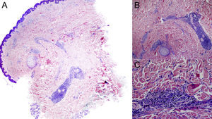 Imagen anatomopatológica. A. Imagen panorámica. Se observa un infiltrado superficial y profundo perivascular y perianexial (hematoxilina-eosina ×20). B. A mayor detalle se observa infiltrado perineural (hematoxilina-eosina ×40). C. Detalle del infiltrado inflamatorio compuesto por células plasmáticas.