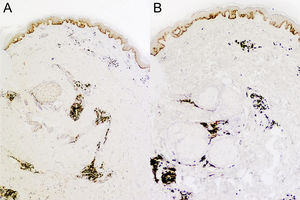 Inmunohistoquímica. A. Positividad kappa. B. Positividad lambda.