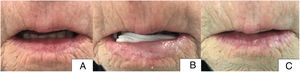 Paciente 3. A) Situación inicial de la paciente antes del tratamiento con afectación del 75% de la superficie del labio inferior (región central y laterales adyacentes a ésta). B) Imagen de la paciente con la crema de aminolevulinato de metilo aplicada y gasa en cara posterior del labio inferior. C) Imagen de la paciente a las 8 semanas del tratamiento. Resolución completa de las lesiones.