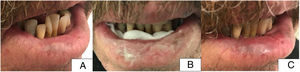 Paciente 4. A) Situación inicial del paciente antes del tratamiento con afectación del 75% de la superficie del labio inferior (lateral derecho y región central). B) Imagen del paciente con la crema de aminolevulinato de metilo aplicada y gasa en cara posterior del labio inferior. C) Imagen del paciente a las 8 semanas del tratamiento. Resolución completa de las lesiones.