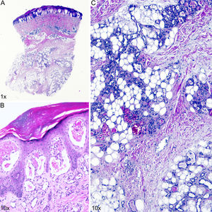 Hematoxilina-eosina, ×1 (A) y ×10 (B y C).