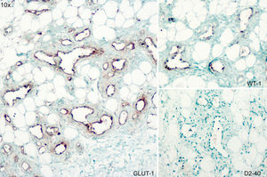 Técnicas GLUT-1, WT-1 y D2-40 señaladas sobre cada imagen, ×10.