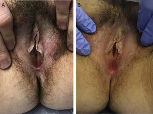 A) Piel blanquecina, liquenificada con placas hipertróficas en labios menores antes del tratamiento. B) Mejoría del color y textura de la piel de labios menores tras cuatro sesiones.