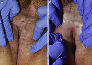 A) Antes del tratamiento. B) Después de cinco sesiones mejoría de la elasticidad de la piel y disminución de las erosiones.