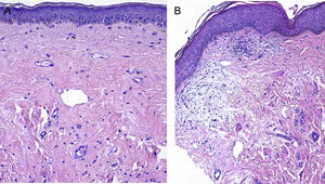 A) Imagen pretratamiento con atrofia epidérmica, colágeno esclerótico e hialinización homogénea de la dermis (519,7 μm). B) Después del tratamiento aumento del espesor de la epidermis y más irregular, disminución del espesor de la banda hialina subepidérmica, dermis laxa con mayor celularidad y menos hialinizada (376,5 μm).
