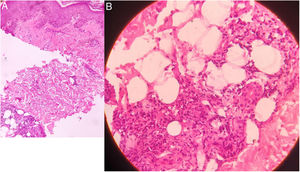 En la histopatología se muestra una infiltración de neutrófilos, linfocitos y células plasmáticas a nivel de la unión dermoepidérmica. En la profundidad de la dermis se observa además la presencia de granulomas de células epitelioides y necrosis fibrinoide, asociado a un infiltrado inflamatorio de neutrófilos, linfocitos, macrófagos y células plasmáticas (A: aumento original ×100; B: aumento original ×400; tinción con hematoxilina/eosina).