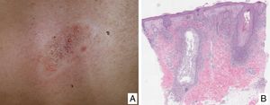 (A) Lesiones papulares y comedogénicas de una micosis fungoide foliculotropa (MFF). (B) Histología de una lesión papular de MFF incipiente o superficial que muestra foliculotropismo linfoide y fenómenos de mucinosis folicular.