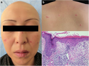 a) Alopecia totalis en el cuero cabelludo y lesiones eritematosas en mejilla, nariz y labios. b) Lesiones eritematosas infiltradas en la parte superior de la espalda. La biopsia cutánea muestra atrofia epidérmica, licuefacción de la membrana basal, células epidérmicas disqueratósicas e infiltración focal de células mononucleares en la dermis.