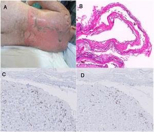 A) Imagen clínica de la paciente 2. B)Hematoxilina-eosina en una biopsia de la paciente 2 (20×). C)Linfocitos CD4+ en una biopsia de piel de la paciente 2 (40×). DLinfocitos CD8+ en una biopsia de piel de la paciente 2 (40×). Nótese que en el infiltrado linfocitario de la dermis la relación CD8/CD4 es de 2,5, menor de 4, por lo que este caso es más sugestivo de EICH.