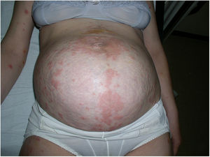 Placas eritematosas muy pruriginosas en el abdomen.