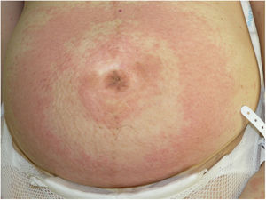 Placas eritematoedematosas dianiformes y vesículas en el abdomen.