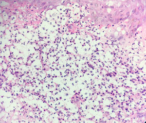 Biopsia de lesión moluscoide de la cara que muestra espacios vacuolados, neutrófilos y estructuras levaduriformes que impresionan tener cápsula, como se ve en criptococosis gelatinosa (H-E 400×).