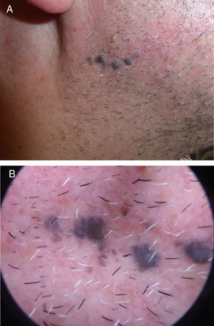 A) Cuatro pápulas de 3-4mm de diámetro, de coloración azulada, con lesiones satélites milimétricas. B) Patrón azul homogéneo en la dermatoscopia.