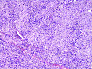 Detalle de intenso infiltrado linfocitario intratumoral. Hematoxilina y eosina, ×100.