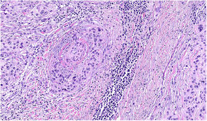 Presencia de células de melanoma en el espacio perivascular (angiotropismo). Hematoxilina y eosina, ×400.