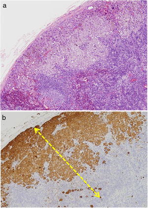 a) Metástasis combinada (subcapsular y parenquimatosa); b) cóctel de melanoma (MelanA, HMB-45 y tirosinasa) y medición del diámetro mayor de la misma.