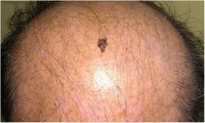 Presentación clínica de la lesión parietal.