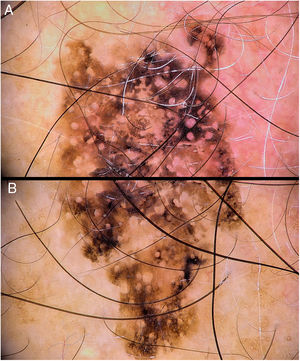 A) Imagen dermatoscópica del polo superior de la lesión. B) Polo inferior.