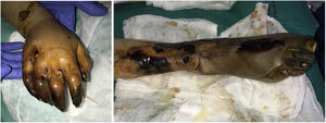 Púrpura fulminans en un paciente con sepsis de origen biliar (cortesía del Dr. Fernando Cabo, Servicio de Dermatología, Hospital Universitario de Orense).