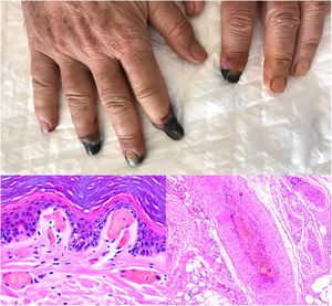Trombopatía por COVID-19. Clínicamente se observa afilamiento distal de varias falanges, con tonalidad negruzca. Proximalmente a estas áreas de isquemia, mácula parduzca de aspecto retiforme residual. Histopatológica derecha: detalle de trombosis en vaso arterial. Histopatológica izquierda: trombos hialinos dentro de los vasos dilatados en dermis papilar.