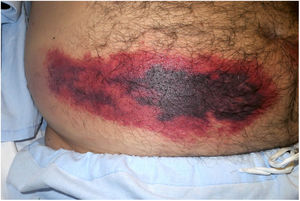 Gran placa purpúrica abdominal con tendencia a la necrosis central en paciente anticoagulado con bemiparina sódica.