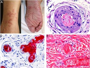 A y B: Lesiones de tipo livedo reticularis en parte inferior de pierna y planta del pie, como forma de presentación de trombocitemia esencial en una paciente de 77 años, sin antecedentes significativos. En la analítica realizada se observó marcada trombocitosis (919.000/mm3) (cortesía de los Dres. Rosario Haro y Luis Requena; Dermatología, Fundación Jiménez Díaz, Madrid). C: Trombocitosis secundaria a un trastorno mieloproliferativo (trombocitemia esencial). Oclusión de la luz de arteriolas por material finamente granular y hemático (H&E 40x). D: Trombocitosis secundaria a un trastorno mieloproliferativo (trombocitemia esencial). Estudio inmunohistoquímico para plaquetas (CD61), que confirma la oclusión de la luz por trombocitos (40x). E: Hemoglobinuria paroxística nocturna. Se observan dos vasos localizados en dermis con trombos de plaqueta y fibrina con mínimo infiltrado linfocitario perivascular (H&E 400x).