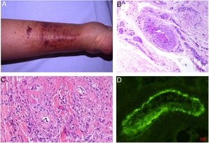A: Crioglobulinemia. Se observan múltiples pápulas purpúricas en la extremidad inferior, acompañadas de descoloración de la piel por hemorragia. B: Crioglobulinemia tipo I. Presencia de un molde hialino intravascular ocluyendo parcialmente la luz del vaso (H&E 100x). C: Crioglobulinemia mixta. Piel que muestra vasos de la dermis reticular con fenómenos de necrosis fibrinoide, suboclusión vascular, leucocitoclasia y necrosis endotelial (H&E 200x). D: Crioglobulinemia. Se aprecian depósitos de IgG en la pared del vaso inflamado mediante estudio de inmunofluorescencia directa (200x).