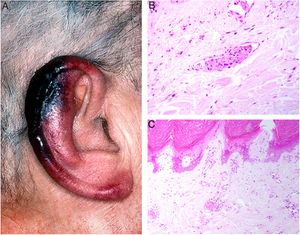A: Criofibrinogenemia. Lesiones eritemato-purpúricas en pabellón auricular, especialmente en lóbulo y hélix, donde las lesiones son necróticas. B: Enfermedad por crioaglutininas: trombos intraluminales con agregados de hematíes, fibrina y polimorfonucleares neutrófilos (H&E 200x). C: Enfermedad por crioaglutininas: necrosis de la epidermis suprayacente con oclusión luminal de los vasos de la dermis superficial (H&E 100x).