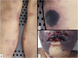Ectima gangrenoso. Autopsia de una paciente severamente neutropénica con sepsis por Pseudomonas aeruginosa y ectima gangrenoso, con lesiones en varias fases de evolución: (a) iniciales en forma de máculas eritematosas en piernas; (b) lesiones más avanzadas negruzcas con borde eritematoso en tronco y (c) necrótico-ampollosas en cara.