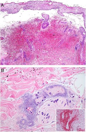 A: Ectima gangrenoso. Infarto hemorrágico cutáneo con separación epidérmica, edema subepitelial y marcada extravasación hemática en dermis. Aspecto basófilo de las paredes de los vasos dérmicos. (H&E 10x). B: Ectima gangrenoso. Paredes vasculares sustituidas por material basófilo de aspecto difuminado, que destruye la pared sin apenas infiltrado inflamatorio. Dicho material está constituido por acúmulos de bacilos Gram negativos (recuadro) correspondientes a Pseudomonas aeruginosa (H&E 40x).