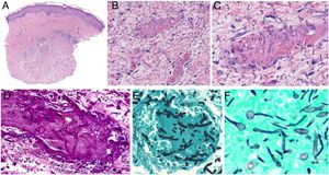 Micosis cutáneas angioinvasivas. A-C: Aspergilosis cutánea angioinvasiva: las hifas ramificadas y septadas ocluyen los vasos dérmicos y atraviesan sus paredes, sin prácticamente componente inflamatorio (A: H&E 20x; B: H&E 200x; C: H&E 400x). D-E: Fusariosis angioinvasiva: las hifas son morfológicamente indistinguibles de las de Aspergillus (D: PAS 400x; E: plata-metenamina 400x). F: Candidiasis invasiva: presencia de levaduras y pseudomicelio (plata-metenamina 600x).