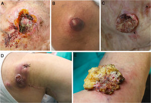 Imágenes clínicas de cinco de los tumores cutáneos incluidos en el estudio. A) recidiva de carcinoma de células escamosas con invasión perineural clínica, localizado en la mejilla. B) Melanoma de extensión superficial de 7,70 mm de Breslow localizado en la rodilla. C) Carcinoma de células escamosas infiltrante de 6,5 mm de espesor, localizado en la mejilla. D) Recidiva de carcinoma de células de Merckel localizado en el hombro derecho. E) Carcinoma verrucoso de 5 cm de diámetro localizado en la rodilla.