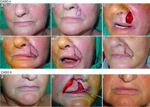 Diseño, técnica quirúrgica y resultado final de la técnica en base a 2 casos representativos. Caso 4. (a) Carcinoma basocelular en el labio superior. (b) Delimitación del tumor con margen para escisión con cirugía de Mohs y adaptación del defecto, de modo que llegue al surco naso-labial y a la línea de unión de la piel del labio superior con el bermellón. (c) Defecto final tras extirpación con bordes libres y escisión de tejido sano superior e inferior. Diseño del colgajo siguiendo el pliegue del surco nasolabial y la línea de unión de la piel del labio superior con el bermellón, acabando ambas líneas en el ángulo de arrugas naturales de la comisura labial. (d) y (e). Colgajo suturado con puntos simples de seda de 6/0. Las cicatrices superior e inferior se esconden en líneas naturales y la cicatriz medial es vertical y paralela a las arrugas. (f) Aspecto al acudir para la retirada de puntos 7 días tras la intervención. Caso 6. (g) Carcinoma basocelular en el labio superior (derecho). (h) Imagen del colgajo que, tras ser labrado en el plano subcutáneo manteniendo un pedículo subcutáneo central que garantice la vascularización, avanza hacia el defecto. Previamente se había extirpado la lesión con cirugía de Mohs. (i) Resultado 6 meses tras la intervención.