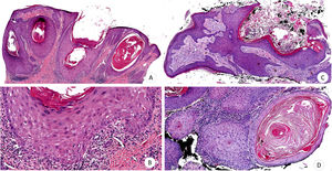 Hiperplasia epidérmica con acantosis, papilomatosis e hiperqueratosis (A-B). Pérdida focal del estrato basal con discreto infiltrado linfocitario (B). Tumoración escamosa, infiltrante y crateriforme (C). Masas dérmicas constituidas por queratinocitos de citoplasma amplio y eosinófilo pálido con discreta atipia nuclear (D) (H-E: A, ×4; B, ×10; C, ×4; D, ×10).