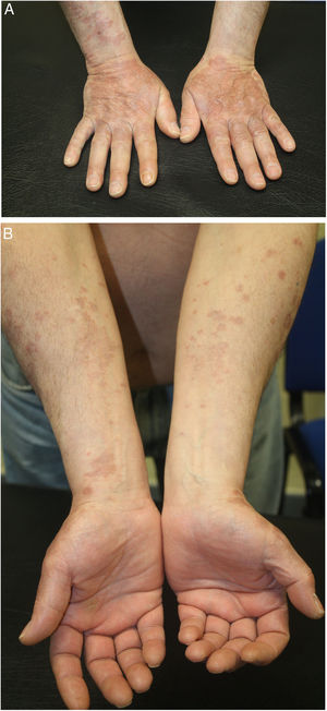 Presentación clínica del paciente. A) Placas eritematoparduzcas arciformes con tendencia a la coalescencia en dorso de manos y cara dorsal de antebrazos. Las lesiones tenían leve infiltración al tacto y carecían de componente epidérmico apreciable. B) Las lesiones se extendían a cara volar de los antebrazos con menor coalescencia y afectación.