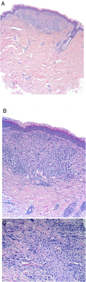 Histología de las pápulas neoformadas tras fotoprovocación. A) Infiltrado dérmico de tipo intersticial bien circunscrito. A pequeño aumento no se observan granulomas ni afectación epidérmica (tinción de hematoxilina-eosina ×2, magnificación ×20). A mayor detalle se observa que dicho infiltrado es de tipo linfohistiocitario, con un componente importante de células de citoplasma grande que envuelven los haces colágenos con un patrón de dermatitis granulomatosa intersticial (tinción de hematoxilina-eosina ×10, magnificación ×100). C) A gran aumento no se observan imágenes de elastofagocitosis, descartando el diagnóstico de granuloma actínico (tinción de hematoxilina-eosina ×20, magnificación ×200).
