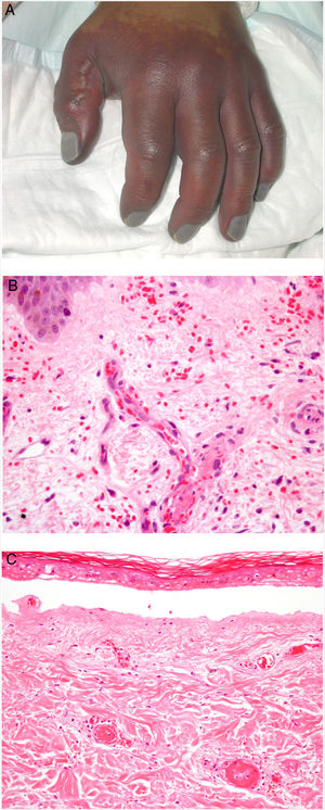 A: Lesión de gangrena simétrica periférica caracterizada por una placa isquémica bien delimitada en la mano izquierda con decoloración azulada de las uñas. B: Trombos de fibrina en vasos del plexo superficial y extravasación hemática dérmica (H&E 400x). C: Lesión de pocos días de evolución en CID. Formación de ampolla subepidérmica con epidermis necrosada y trombos de fibrina en pequeños vasos sanguíneos dérmicos (H&E 200x).