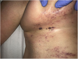 Carcinoma telangiectático en paciente con carcinoma de ovario en estadio IV. Placa eritematosa indurada en región mamaria con telangiectasias en superficie y lesiones pseudovesiculosas.
