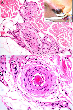 Síndrome antifosfolípidos catastrófico. Necrosis cutánea en pirámide nasal (recuadro). A. Trombosis venosa (H&E, 100x). B. Trombosis en arteriola (H&E, 200x).