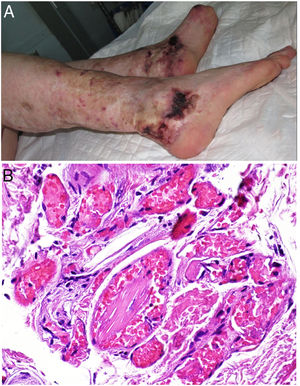 A: Cristalglobulinemia: lesiones ulceradas, livedoides y purpúricas localizadas en extremidades inferiores. B: Cristalglobulinemia. Vasos de pequeño y mediano calibre con oclusión luminal por estructuras cristaloides de disposición paralela (H&E 400x).